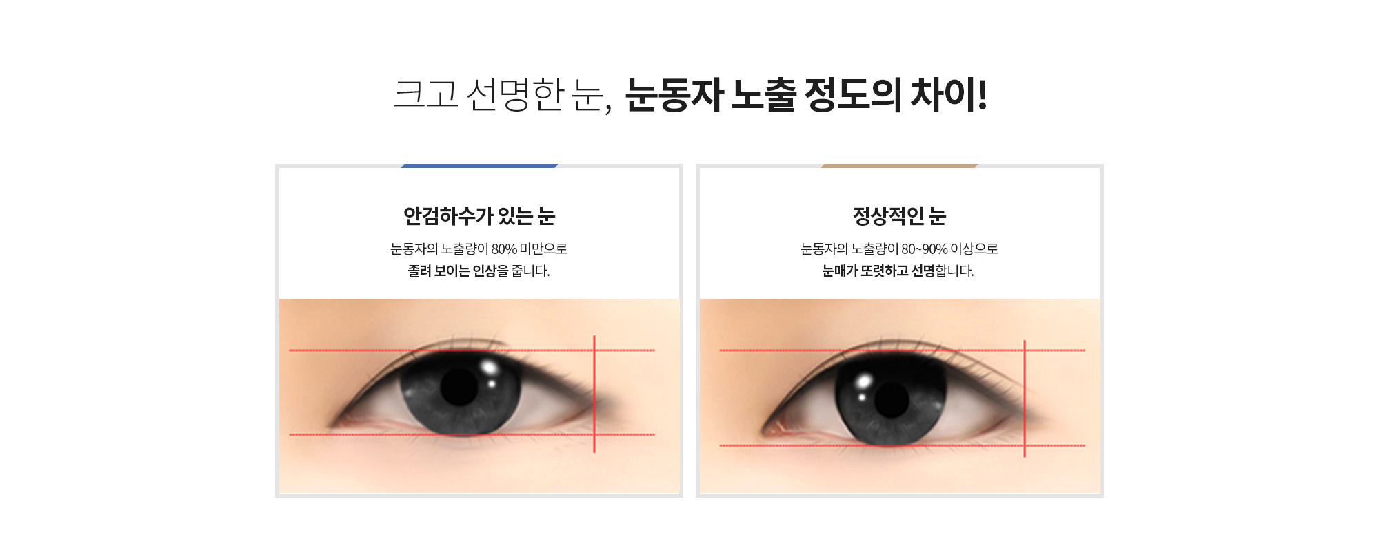 크고 선명한 눈, 눈동자 노출 정도의 차이! 
		안검하수가 있는 눈
		눈동자의 노출량이 80% 미만으로 
		졸려 보이는 인상을 줍니다. 

		정상적인 눈
		눈동자의 노출량이 80~90% 이상으로 눈매가 또렷하고 선명합니다.