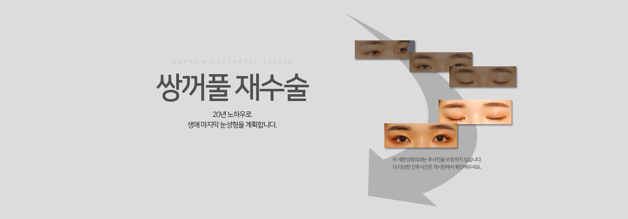 쌍꺼풀 재수술 20년 노하우로 생애 마지막 눈성형을 계획합니다.