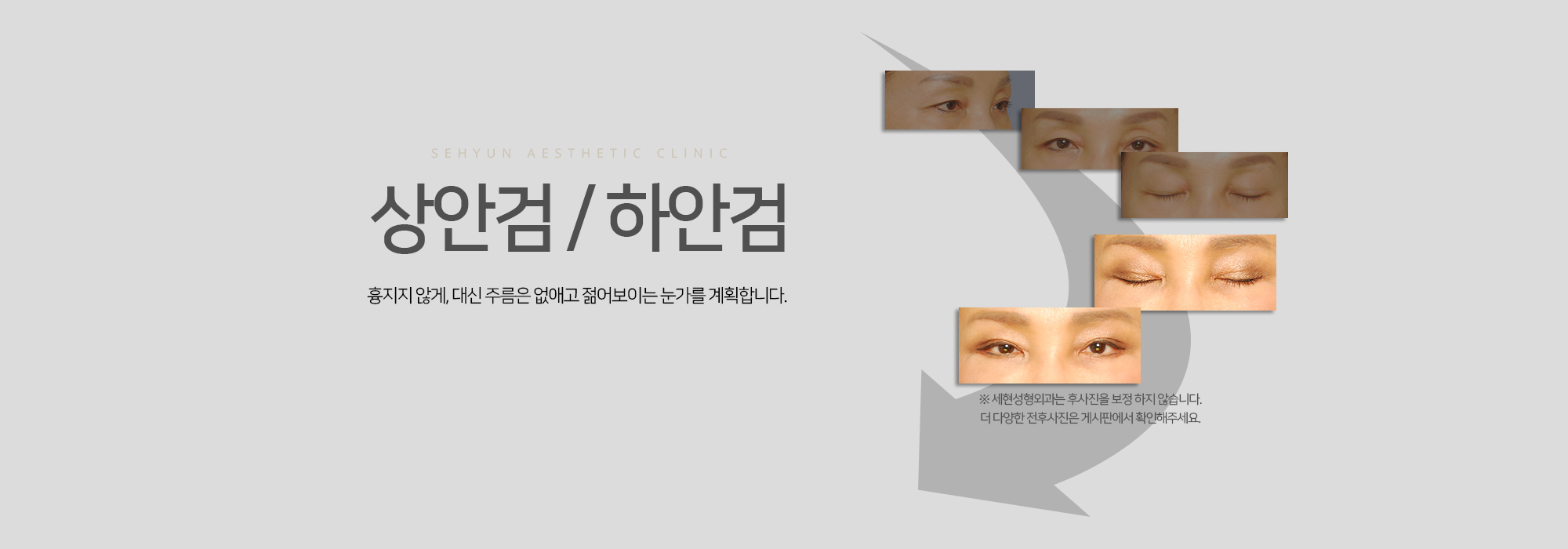 상안검 / 하안검 흉지지 않게, 대신 주름은 없애고 젊어보이는 눈가를 계획합니다.