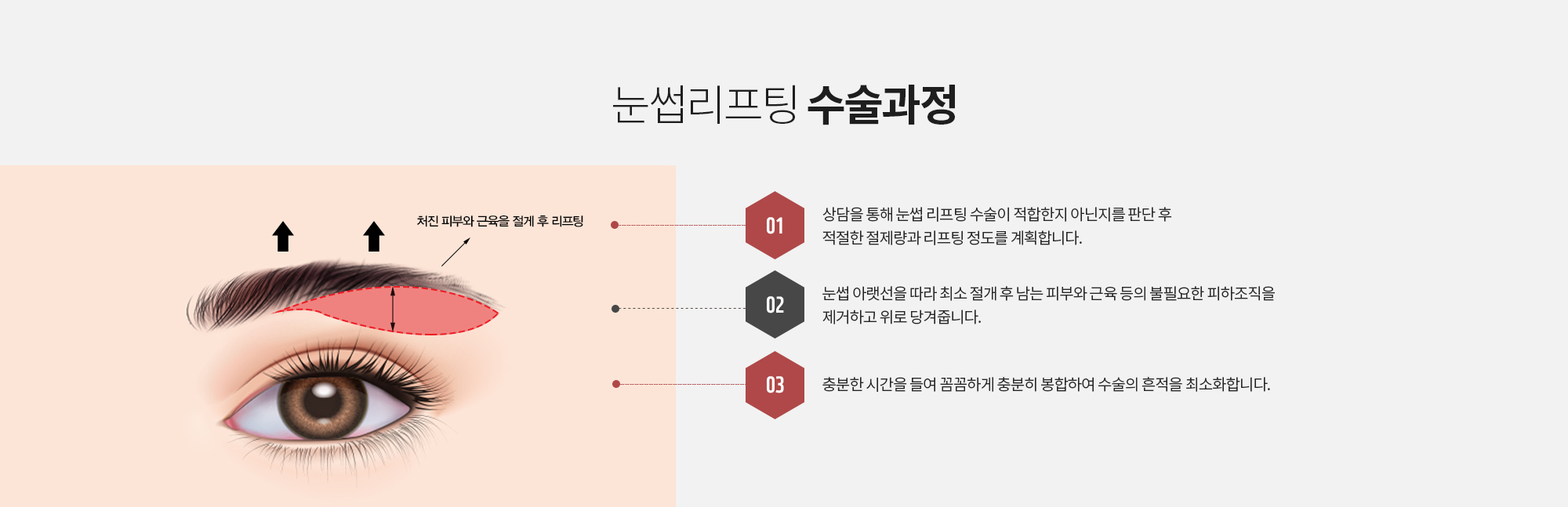 눈썹리프팅 수술과정
		STEP 1. 상담을 통해 눈썹 리프팅 수술이 적합한지 아닌지를 판단 후 적절한 절제량과 리프팅 정도를 계획합니다. 
		STEP 2. 눈썹 아랫선을 따라 최소 절개 후 남는 피부와 근육 등의 불필요한 피하조직을 제거하고 위로 당겨줍니다. 
		STEP 3. 충분한 시간을 들여 꼼꼼하게 충분히 봉합하여 수술의 흔적을 최소화합니다