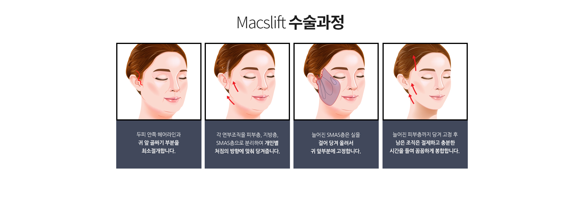 Macslift 수술과정
		두피 안쪽 헤어라인과 귀 앞 골짜기 부분을 최소절개합니다.
		각 연부조직을 피부층, 지방층, SMAS층으로 분리하여 개인별 처짐의 방향에 맞춰 당겨줍니다. 
		늘어진 SMAS층은 실을 걸어 당겨 올려서 귀 앞부분에 고정합니다. 
		늘어진 피부층까지 당겨 고정 후 남은 조직은 절제하고 충분한 시간을 들여 꼼꼼하게 봉합합니다.