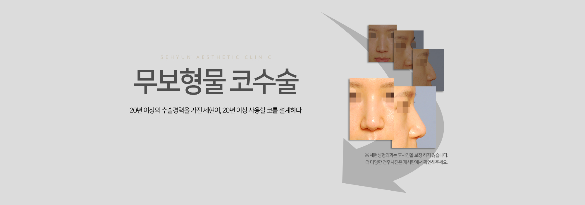 무보형물 코수술 20년 이상의 수술경력을 가진 세현이, 20년 이상 사용할 코를 설계하다