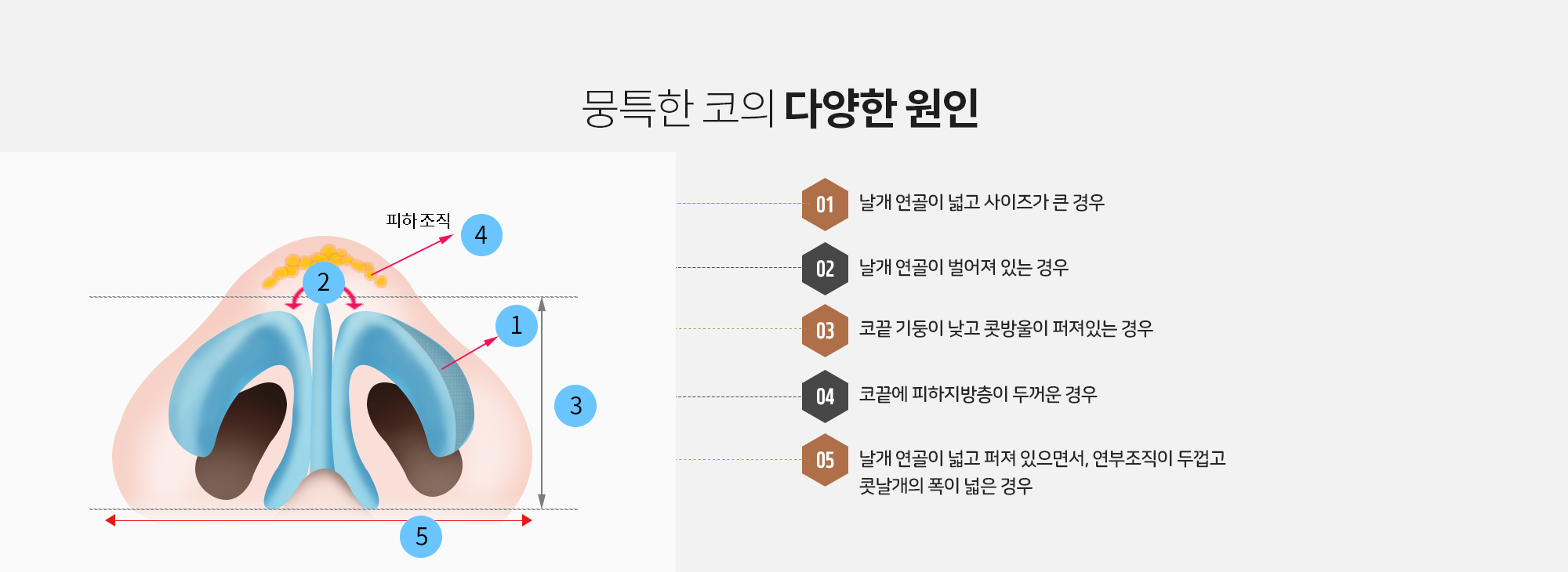 뭉특한 코의 다양한 원인 
		1. 날개 연골이 넓고 사이즈가 큰 경우 
		2. 날개 연골이 벌어져 있는 경우
		3. 코끝 기둥이 낮고 콧방울이 퍼져있는 경우 
		4. 코끝에 피하지방층이 두꺼운 경우 
		5. 날개 연골이 넓고 퍼져 있으면서, 연부조직이 두껍고 콧날개의 폭이 넓은 경우