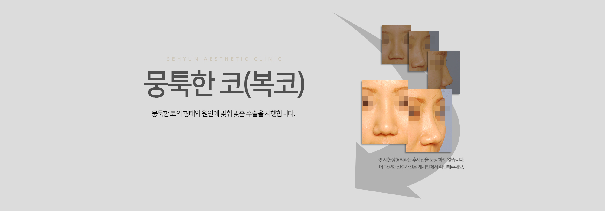 뭉툭한 코 뭉툭한 코의 형태와 원인에 맞춰 맞춤 수술을 시행합니다.